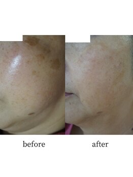 アップルミント/＜フェイシャル＞before・after