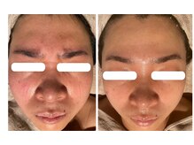 ハピエスト 田辺店/水光ピール