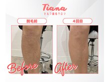 ティアナ 秋田大館店(Tiana)/足脱毛　Before＆After
