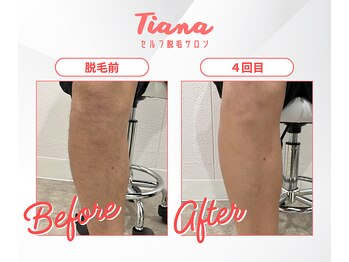 ティアナ 秋田大館店(Tiana)/足脱毛　Before＆After