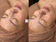 肌質改善の王道！【ニキビ/毛穴/トーンアップ】肌育ピーリング☆ララピール7980円