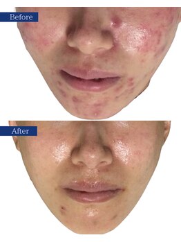 ビズビズ(bisebise)/メンズニキビ学割U24★大阪梅田