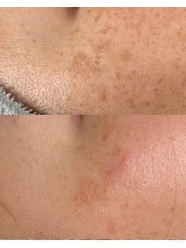 ライリー(Rairy)/最強肌質改善プラズマカリファEX