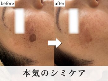 ぺルラ 島田駅前店(Perla)の写真/【光フェイシャル】何をしても変わらなかった長年のシミに！根本ケアで変化を実感、自信の持てる肌へ☆