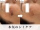 ぺルラ 島田駅前店(Perla)の写真/【光フェイシャル】何をしても変わらなかった長年のシミに！根本ケアで変化を実感、自信の持てる肌へ☆