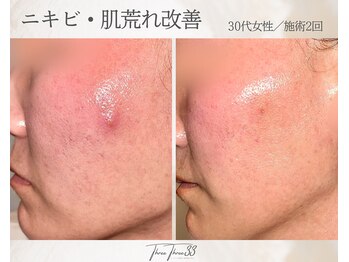スリースリー 恵比寿(THREE THREE)/ニキビ・肌荒れケア