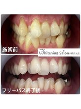 ホワイトニングサロン 京都烏丸店/ホワイトニング施術例　