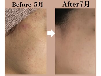 ユーアンドハニー(U&Honey.)/ハーブピーリング/ニキビ/毛穴