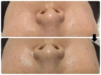 エフェクト 塚口店(effect)/Before After 20代/2回目