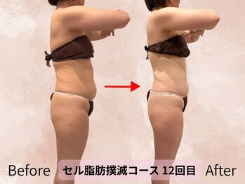 ハナ チュチュ(Hana chuchu)/セル脂肪撲滅コース 12回目