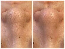 ヒスイ バイ アメイジング(Hisui by AMAZING)/【毛穴ケア】韓国式3D毛穴洗浄