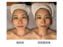 ゆきだまアロマの雰囲気（筋肉骨格リンパ集中ケア1回でこの変化！少し整えて美人顔。）