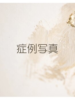 ジフィー(Gify)/筋膜リリースカッター症例写真