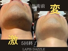 ラピスダズル(LAPIS DAZZLE)/ヒゲ脱毛☆途中経過(5回終了後)