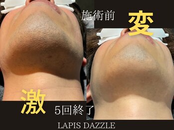 ラピスダズル(LAPIS DAZZLE)/ヒゲ脱毛☆途中経過(5回終了後)