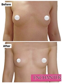 アンシャンテ(ENCHANTER)/光バストアップ