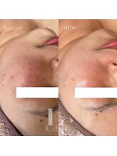 ルシェリア(Le cherien)/シミくすみ色ムラ改善にオススメ