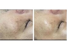 ラエッセ 目黒 白金台店(LAESSE)/毛穴・美白専門店 LAESSE 白金台