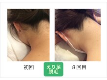 高出力脱毛大人気◎学生の方はU24学割でお得に脱毛ができます！