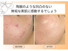 土台を整えて繰り返すニキビに終止符を！