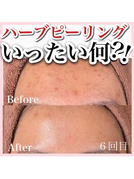 アルムダアクア 天王寺店(Aleumda AQUA)/ハーブピーリング/大阪/天王寺