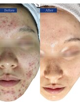 ビズビズ(bisebise)/メンズニキビ学割U24★大阪梅田