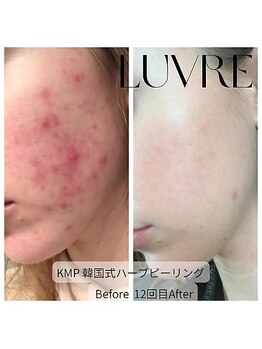 ルーヴレ(LUVRE)/KMPハーブピーリング