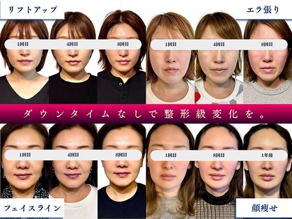 フレキシボディ(FlexiBody)の写真