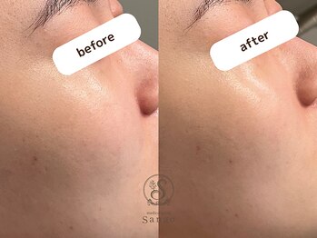 サンゴ(Sango)/小皺/毛穴/ハリ/ツヤ改善