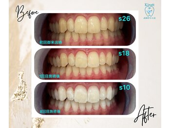 キラット 高知中万々店(Kiratt)/【クリスタルホワイトニング】