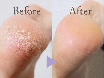 アケア(Acare)の写真/【自信の持てる素足に！】足の爪先からかかとまでピカピカふわふわに☆嬉しい膝下保湿トリートメント付き◎