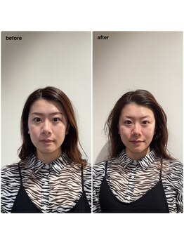 アネラ 本町(ANERA)/小顔矯正&毛穴洗浄BeforeAfter