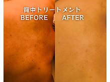 アクネ菌ケア専門サロン ベネーブ 武蔵小杉店/背中トリートメント