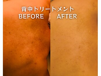 アクネ菌ケア専門サロン ベネーブ 武蔵小杉店/背中トリートメント