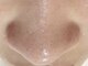 エミアンジュ(Emi Ange)の写真/【いちご鼻】肌質改善は毛穴ケアから！話題沸騰中の毛穴洗浄ができるサロン◎