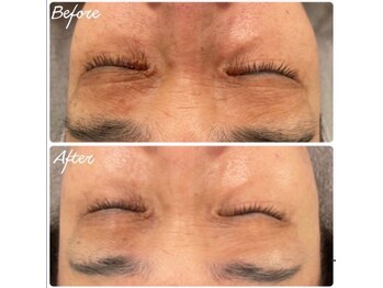 ラ シルク(La silk)/ヒト幹細胞導入