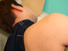 きりん接骨鍼灸院 尼崎武庫之荘店/肩の鍼施術（インピンジメント）