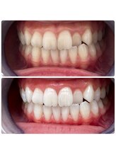 エクシアホワイトニング 日本橋店/ホワイトニング