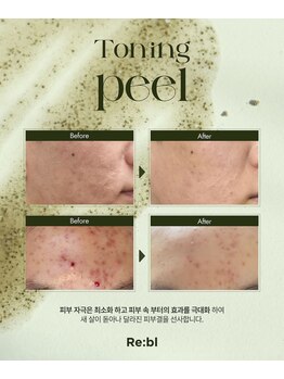 ルミライズ(Lumirise)/ハーブピーリングでつやっと美肌