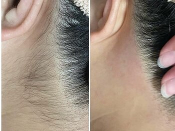 ウル(ulu)の写真/【Wax脱毛で後ろ姿もキレイに♪】成人式・ブライダルなどの大事なイベント前に★フェイスWaxや眉毛Waxも◎