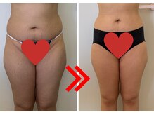 脂肪冷却！一度冷やした脂肪細胞は2度と再生しません！