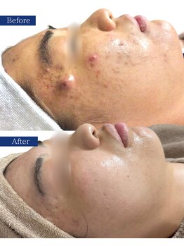 ビズビズ(bisebise)/メンズニキビ学割U24★大阪梅田