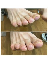 足のトラブルセンター 狸小路店/男性の足元にも美しい爪を