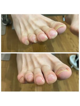 足のトラブルセンター 狸小路店/男性の足元にも美しい爪を
