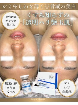 ソユ(SOYOU)/施術* ダクトピール