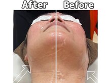 エピ エピ プラス イオンモール宇城店(EPI*EPI+)/光フェイシャル Before→After