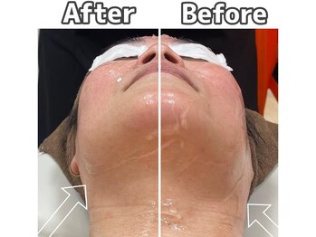 エピ エピ プラス イオンモール宇城店(EPI*EPI+)/光フェイシャル Before→After