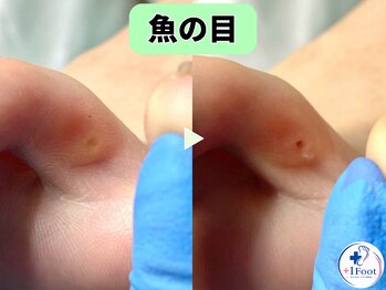 プラスワンフット 本厚木(+1 Foot)/タコ・魚の目ケア！痛みから解放
