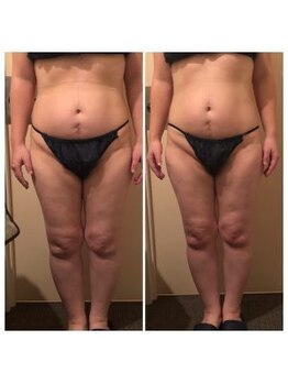 レナンセラ バイ カトレアグループ(Renanthera by カトレアGroup)/最新!最強痩身ハイパーナイフ