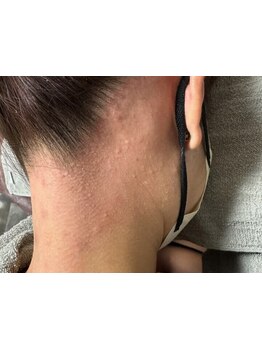 ムダ毛ケアをしたい